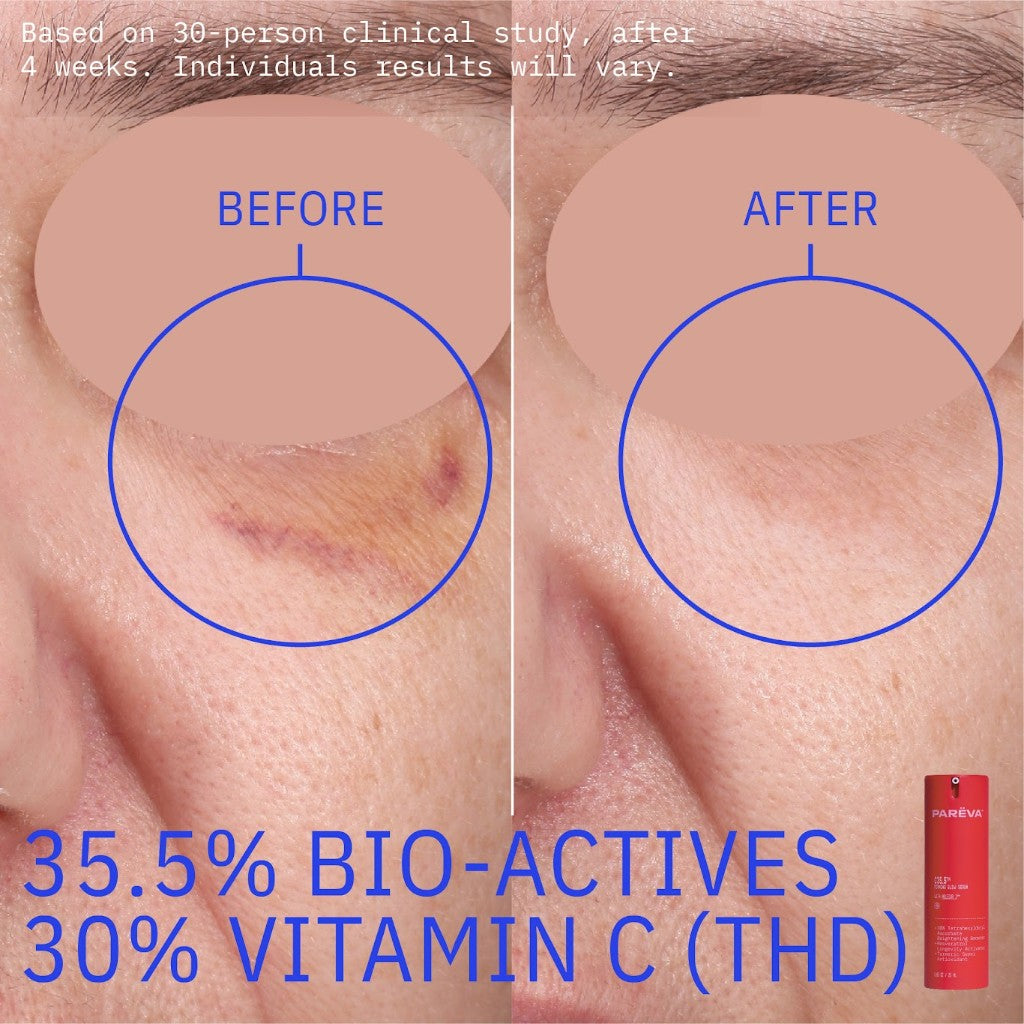 C35.5™ before and after dark spots