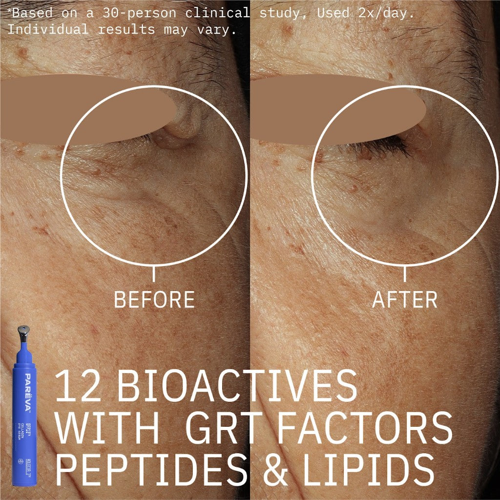 GFP12™ Collagen Eye Serum before and after crow's feet